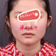 杭州華山連天美醫(yī)療美容醫(yī)院下頜角磨骨恢復過程圖，再也不是路人