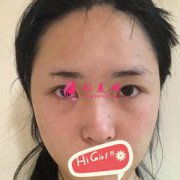 北京京民整形外科假體隆鼻親身體驗 鼻型立體很自然哦