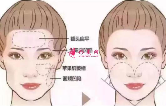 自體脂肪填充臉部有什么好處