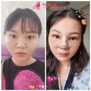廣州可玉醫(yī)療美容鼻綜合術(shù)后恢復(fù)情況對比