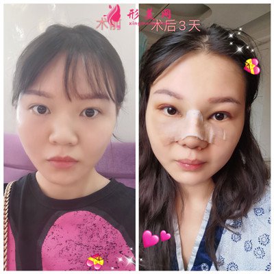 廣州鼻綜合術(shù)后恢復(fù)情況對比