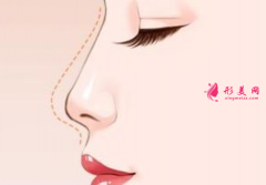 隆鼻假體取出后會(huì)怎么樣？