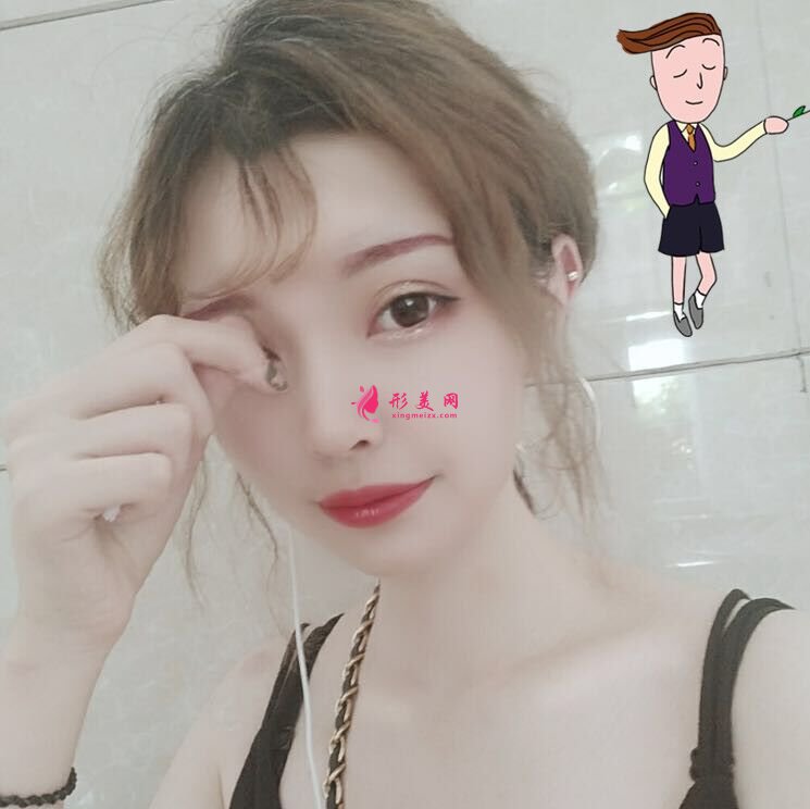 自體脂肪填充