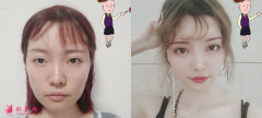 自體脂肪填充全臉效果怎么樣，60天恢復(fù)實(shí)例