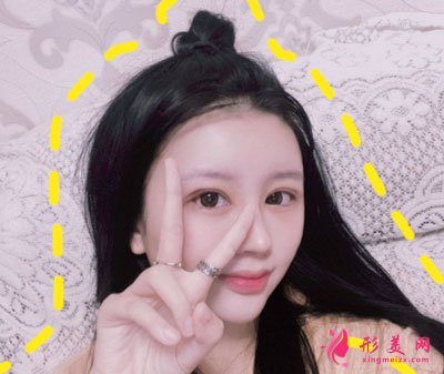 天津伊頌整形眼部整形案例
