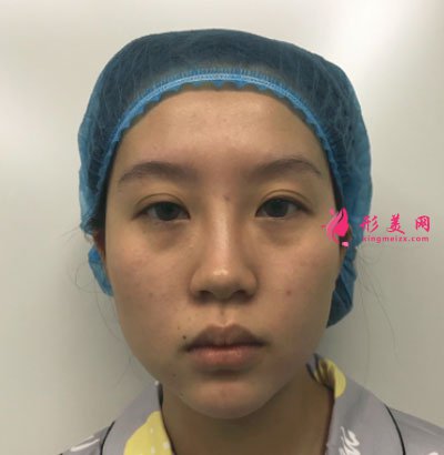天津伊頌整形眼部整形案例