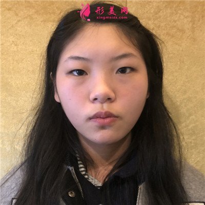 成都切開(kāi)雙眼皮術(shù)后恢復(fù)情況分享