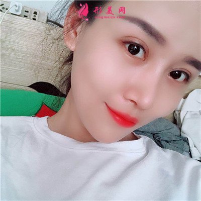 長春自體肋軟骨隆鼻術(shù)后效果分享
