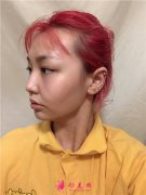 南京連天美醫(yī)院吸脂瘦臉術(shù)后恢復(fù)效果反饋