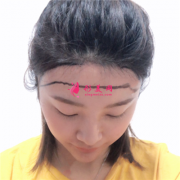廣州新生種植發(fā)際線手術(shù)術(shù)后效果分享