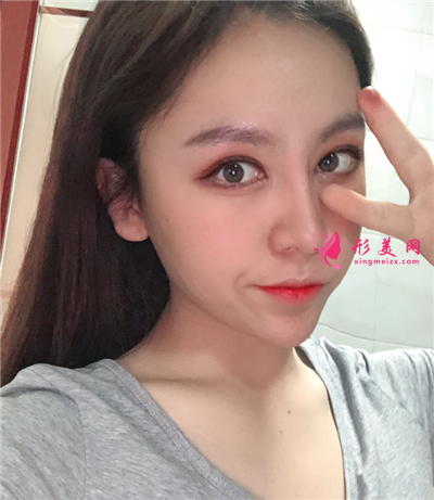 成都鼻綜合案例分享，術(shù)后秒變小美女~