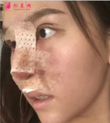 成都軍大醫(yī)院鼻綜合案例分享，術(shù)后秒變小美女~
