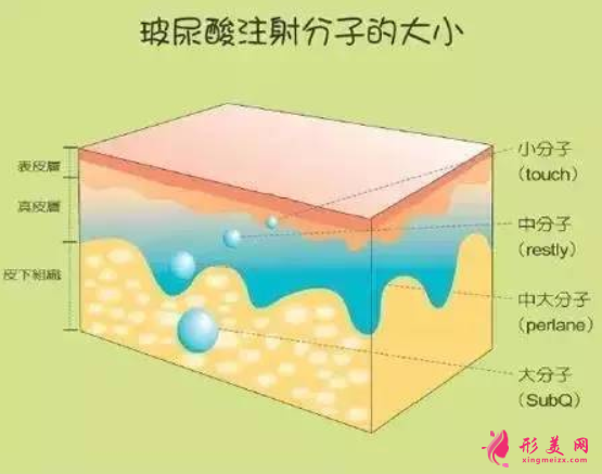 玻尿酸填充臉部效果保持多久