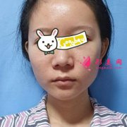 北京東方瑞麗整形醫(yī)院熱瑪吉除皺逆襲蛻變 大媽變少女