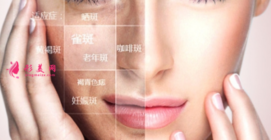 激光祛斑會(huì)影響皮膚的健康嗎