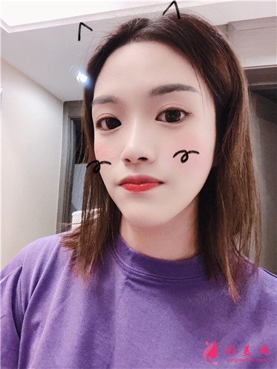 杭州光子嫩膚恢復(fù)情況反饋