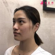 杭州吉奧醫(yī)療美容診所光子嫩膚恢復(fù)情況反饋