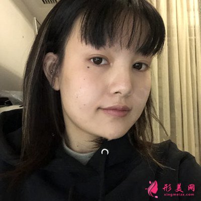成都小姐姐吸脂瘦臉術(shù)后恢復(fù)情況反饋