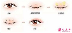 想知道無痕割雙眼皮需要多久恢復嘛？小編帶你了解！