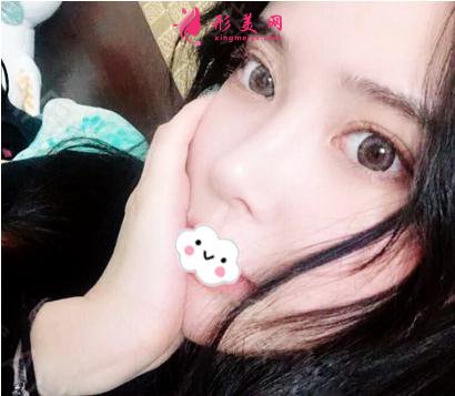 劉彥軍醫(yī)生做隆鼻修復怎么樣？技術(shù)+案例圖盤點