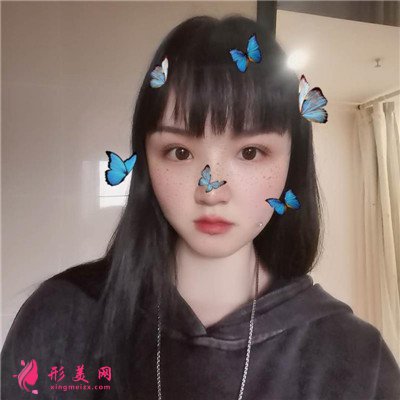 重慶切開雙眼皮術(shù)后恢復(fù)情況分享