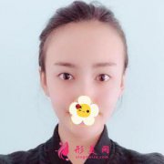 成都星美整形醫(yī)院全切雙眼皮術(shù)后即刻圖 眼睛大了一倍不止