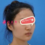 廣州博仕整形醫(yī)院下頜角磨骨案例 臉小了一圈 效果堪比換頭