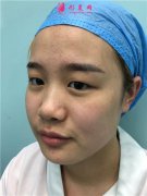 杭州華山連天美小姐姐眼部綜合術(shù)后效果反饋