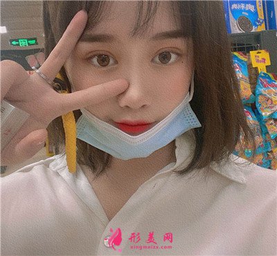 杭州小姐姐眼部綜合術(shù)后效果反饋