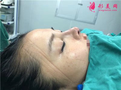 深圳自體肋軟骨隆鼻術(shù)后恢復(fù)情況對(duì)比