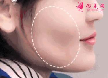 自體脂肪填充面部多少錢