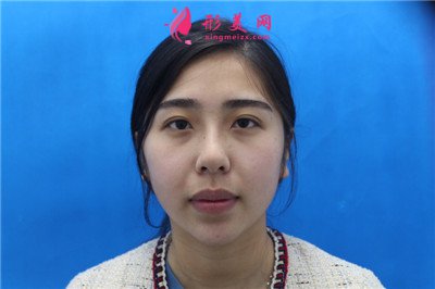 揚州切開雙眼皮術(shù)后恢復(fù)效果反饋