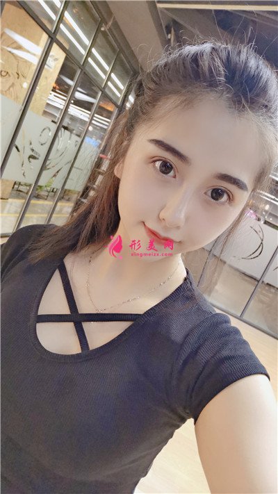 揚州切開雙眼皮術(shù)后恢復(fù)效果反饋