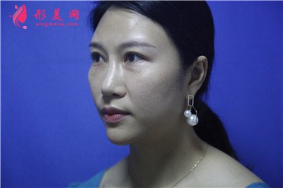 深圳鼻綜合手術(shù)術(shù)后效果分享