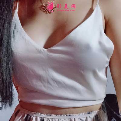 成都美極整形做隆胸術(shù)后30天圖片