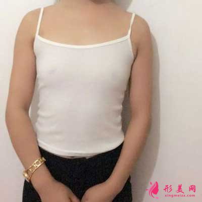 成都美極整形做隆胸術(shù)前圖片