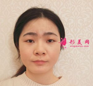 南京美貝爾整形醫(yī)院切開(kāi)雙眼皮案例