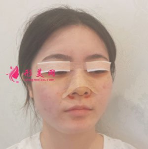 南京美貝爾整形醫(yī)院切開(kāi)雙眼皮案例