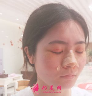 南京美貝爾整形醫(yī)院切開(kāi)雙眼皮案例