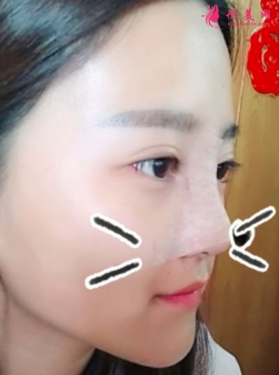 鄭州締萊美醫(yī)療美容醫(yī)院鼻部多項(xiàng)案例