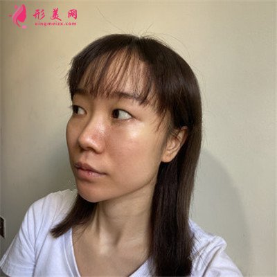 蘭州光子嫩膚術后恢復效果展示