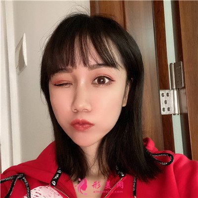 蘭州光子嫩膚術后恢復效果展示
