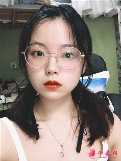 重慶切開雙眼皮術(shù)后恢復(fù)情況案例分享