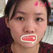 重慶東方整形醫(yī)院鼻綜合個(gè)人經(jīng)歷分享 顏值提升一大截