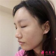 重慶軍美醫(yī)療整形自體脂肪面部填充案例反饋