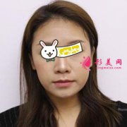 南京連天美整形醫(yī)院面部吸脂半個(gè)月效果圖 同事都夸我好美