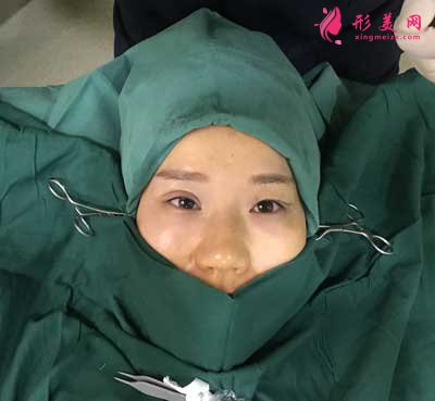 在上海愉悅美聯(lián)臣醫(yī)療美容醫(yī)院做全切雙眼皮手術(shù)后
