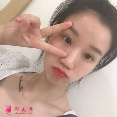 在上海愉悅美聯(lián)臣醫(yī)療美容醫(yī)院做全切雙眼皮手術(shù)后200天