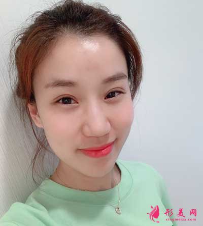 在上海愉悅美聯(lián)臣醫(yī)療美容醫(yī)院做全切雙眼皮手術(shù)后10天