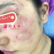 成都潤禾整形醫(yī)院激光祛斑案例 斑點不見了 皮膚白嫩光滑